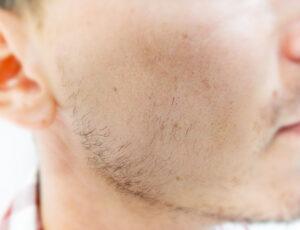 Implante de barba con técnica FUE “EXCLUSIVE” o "SRV"