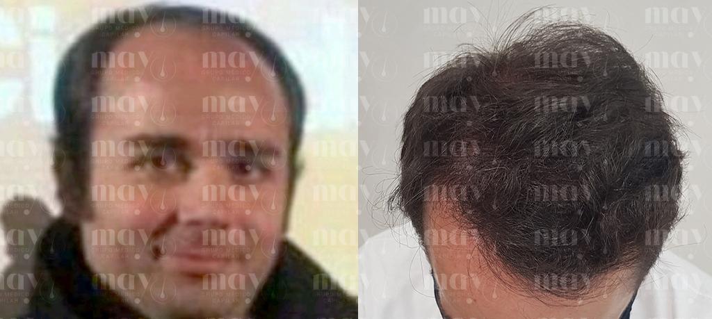 antes y despues del implante capilar en un hombre