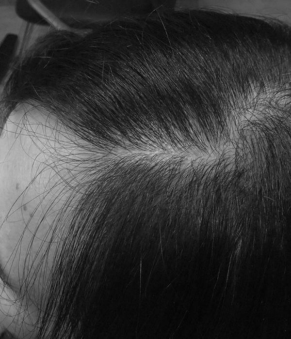 resultado despues de un trasplante de pelo en una mujer
