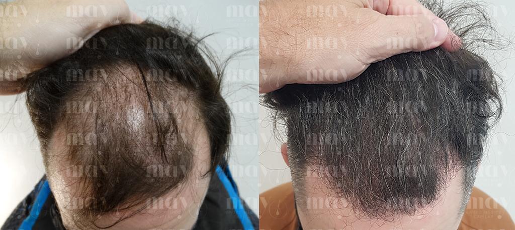 injerto de pelo antes y despues en zona frontal pronunciada