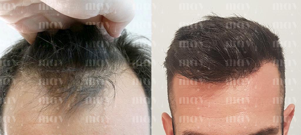 implante de cabello en un hombre antes y despues en la parte frontal