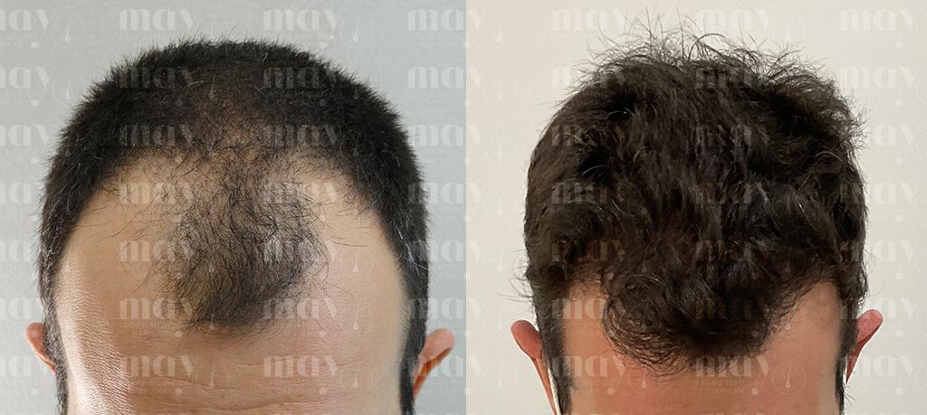 trasplante de pelo antes y despues en la zona frontal